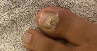 toenail problems