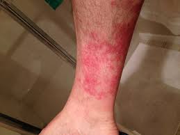 It has been updated as of january 2020. How Can I Get Rid Of Heat Rash Between My Legs