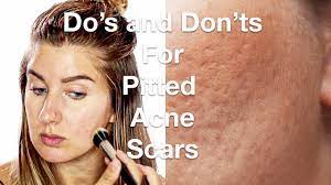 pitted acne scars icepick scars