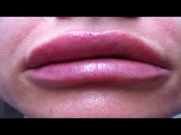 swollen lip from an insect bite