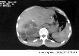 Septated cystic lesion stage 3: Capsulorrhaphy In The Management Of Liver Hydatid Cyst Annals Of Hepatology