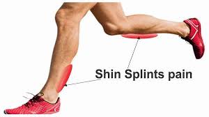 shin splint pain foot speicalist