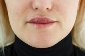 how long does lip filler bruising last