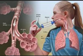 Image result for asthma causes