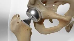 Image result for icd-10-pcs code for hemiarthroplasty hip
