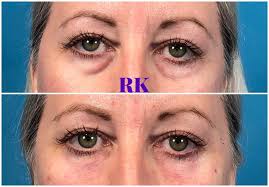 lower eyelid rejuvenation how to fix