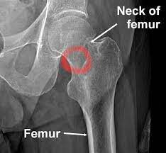 femur stress fracture symptoms
