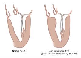 hypertrophic cardiomyopathy causes and