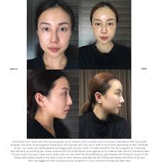 cinderella plastic surgery clinic korea
