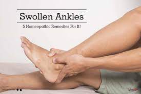 swollen ankles 5 homeopathic remes