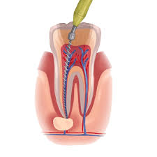 periodontal flap surgery