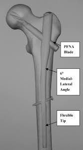 the ao asif proximal fem nail