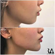 Done with your soft jaw line? Dr Rami Abadi General Dermatology Cosmetic Dermatology And Laser Specialist Beirut Lebanon