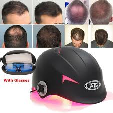 Notable hair loss/thinning onset within the past five years. New 128 Diodes Laser Cap Lllt Hair Regrowth Therapy Hair Loss Treatment Helmet Wish