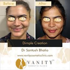 dimple creation a procedure to get