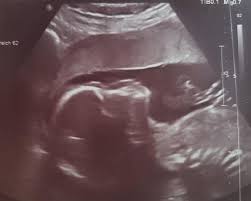 Auch die augenhöhlen werden immer. Ultraschallbilder Mehr Als 50 Bilder Aus Der Schwangerschaft Faminino