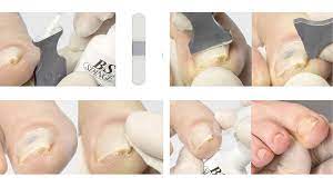 treating ingrown toenails without