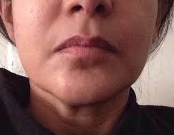 how to get rid of dent above mouth photo