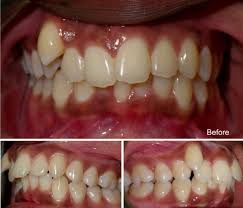 Numbing the pain away with some oral gel can also be helpful. When Why You Need Tooth Extraction For Orthodontic Treatment