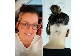 Read about alopecia areata causes, symptoms (balding), diagnosis, and hair loss treatment (shampoo). Aus Dem Leben Eines Alopecianers Mirjam Kalbermatten Kopfrausch Deutschland