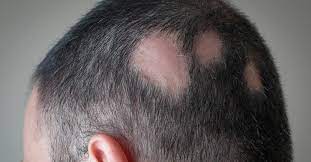 autoimmune disorders and your hair loss