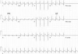Acute pericarditis is a type of pericarditis (inflammation of the sac surrounding the heart, the pericardium) usually lasting less than 6 weeks. Acute Myocarditis And Pericarditis In Children American Academy Of Pediatrics