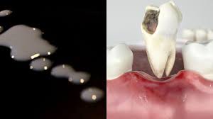 Menggunakan kandungan fluoride terbukti ampuh mengatasi sakit gigi, karena membantu memulihkan enamel gigi berlubang. Air Mani Jadi Cara Mengatasi Gigi Berlubang Apa Efektif