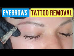 eyebrow tattoo removal