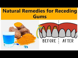 natural remes for receding gums 2021