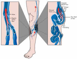 Why vein care is covered by insurance? Varicose Veins Department Of Surgery Suny Upstate Medical University