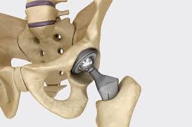 hip replacement hip knee orthopaedics