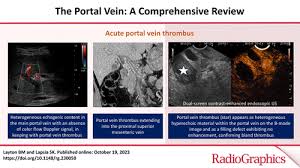The Portal Vein A Comprehensive Review