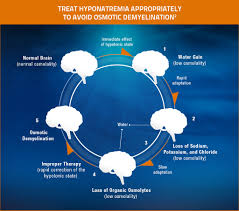 hyponatremia management samsca