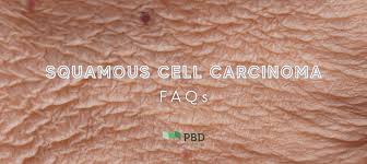 questions about squamous cell carcinoma
