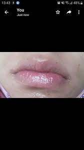 dermatologist for itchy lip line