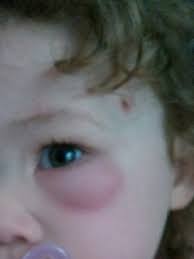 ot toddler has red puffy eye babycenter