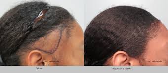 Fut (follicular unit transplant / strip method). African American Hair Transplants By Dr Sean Behnam