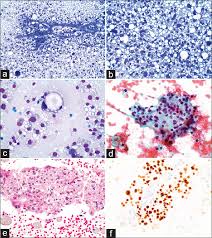 It is normally carried out on thyroid nodules when they are suspected to be your doctor and cytologist will give you excellent guidance on any preparations needed. Fine Needle Aspiration Cytology Of A Thyroid Nodule Challenging Morphologic Considerations Cytojournal