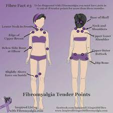 Cute Tender Points Chart Fibromyalgia Fibromyalgia