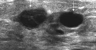 Early signs of breast cancer in women: Breast Ultrasound Cancer Vs Benign Canceroz