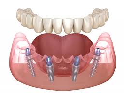 what exactly are all on 4 dental implants
