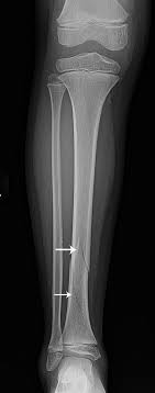 walk fractures of the tibia and fibula