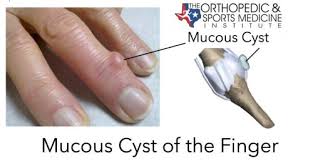 mucous cyst of the finger