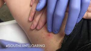 inflamed ingrown hair removal you