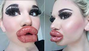 woman with world s biggest lips says
