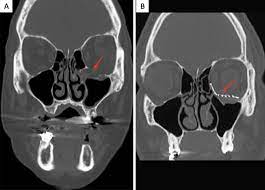 orbital floor fractures