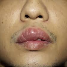upper lip swelling
