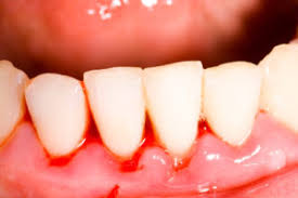 Un bain de bouche à l'eau tiède contenant une solution antiseptique peut calmer une rage de dents. Hemorragie Dentaire Pourquoi Ce Sang Et Comment Reagir