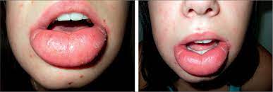 persistent swollen lip cheilitis