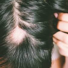 for alopecia areata and bald patches